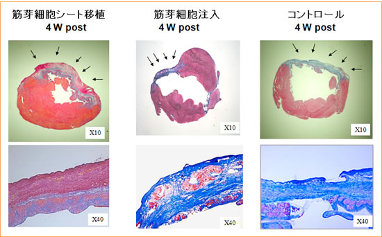 心筋梗塞部位への筋芽細胞移植