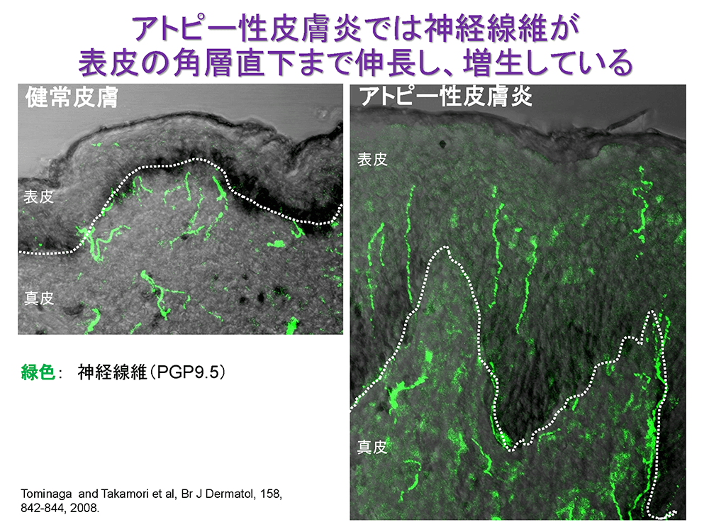 アトピー性皮膚炎では神経繊維が表皮の角層直下まで伸長し、増生している