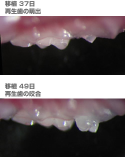 移植後49日で機能的な歯ができた